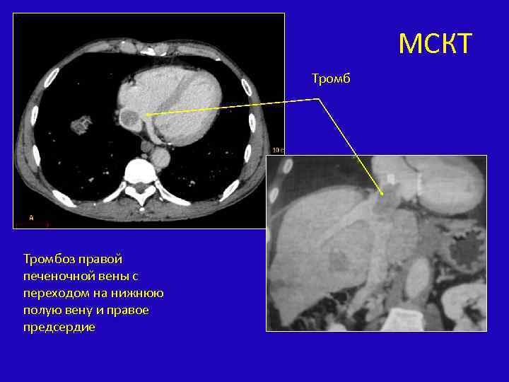 МСКТ Тромбоз правой печеночной вены с переходом на нижнюю полую вену и правое предсердие