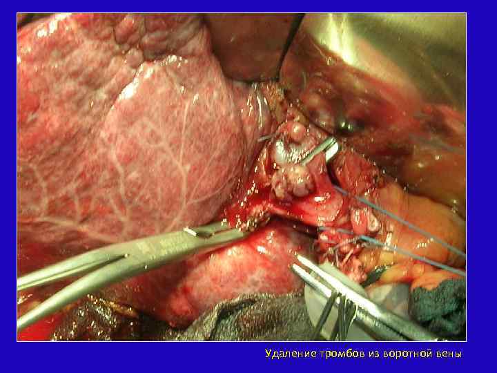 Удаление тромбов из воротной вены 