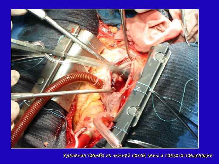 Удаление тромба из нижней полой вены и правого предсердия 