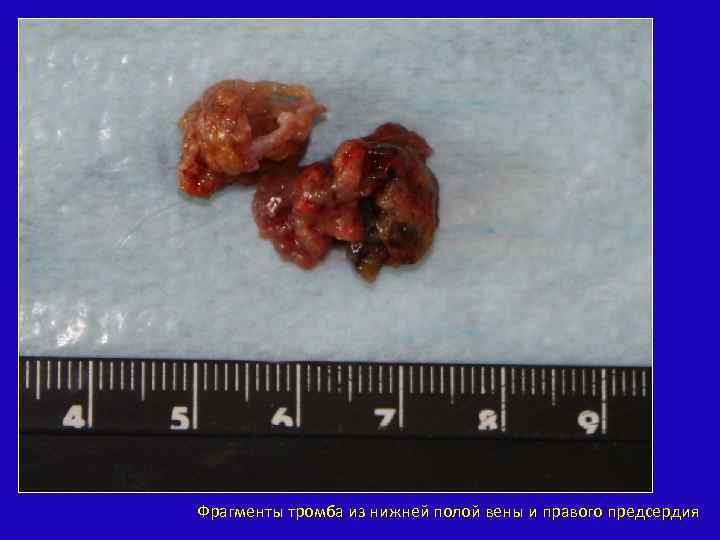 Фрагменты тромба из нижней полой вены и правого предсердия 