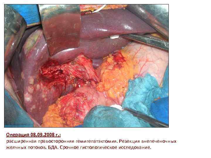Операция 08. 09. 2008 г. : расширенная правосторонняя гемигепатэктомия. Резекция внепеченочных желчных потоков. БДА.