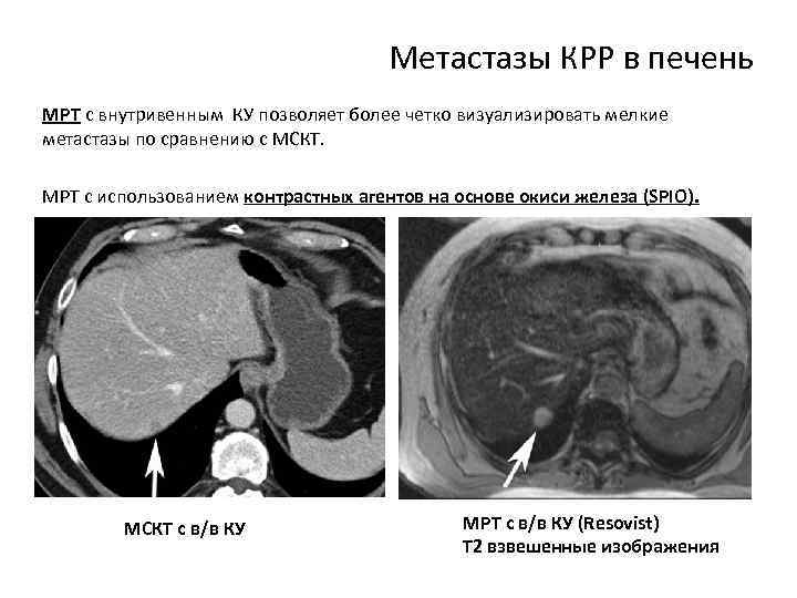Метастазы КРР в печень МРТ с внутривенным КУ позволяет более четко визуализировать мелкие метастазы