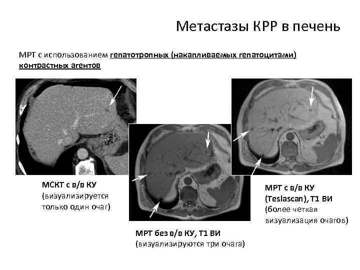 Метастазы КРР в печень МРТ с использованием гепатотропных (накапливаемых гепатоцитами) контрастных агентов МСКТ с