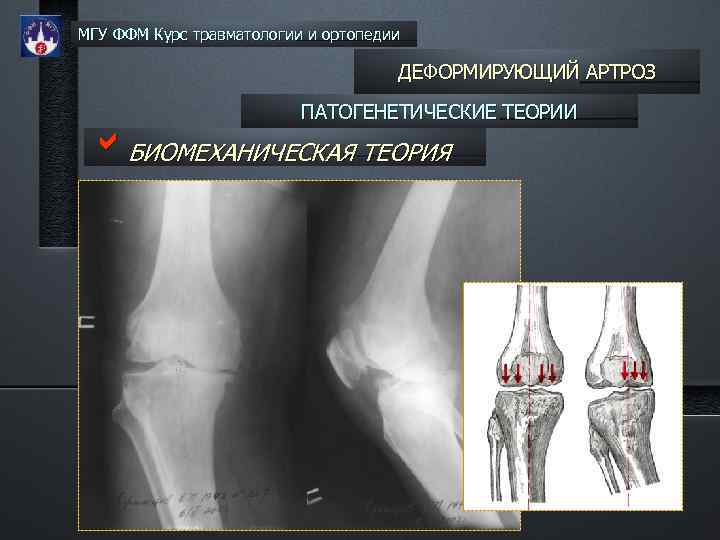 МГУ ФФМ Курс травматологии и ортопедии ДЕФОРМИРУЮЩИЙ АРТРОЗ ПАТОГЕНЕТИЧЕСКИЕ ТЕОРИИ b. БИОМЕХАНИЧЕСКАЯ ТЕОРИЯ 