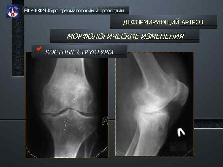 МГУ ФФМ Курс травматологии и ортопедии ДЕФОРМИРУЮЩИЙ АРТРОЗ МОРФОЛОГИЧЕСКИЕ ИЗМЕНЕНИЯ b. КОСТНЫЕ СТРУКТУРЫ 