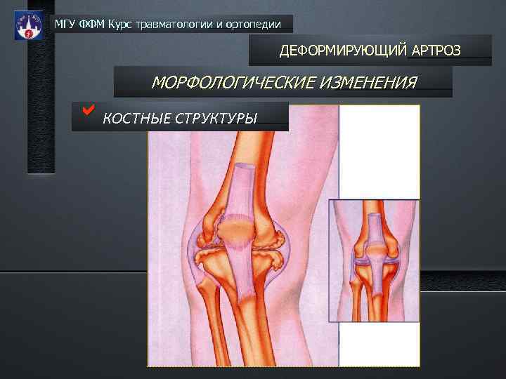 МГУ ФФМ Курс травматологии и ортопедии ДЕФОРМИРУЮЩИЙ АРТРОЗ МОРФОЛОГИЧЕСКИЕ ИЗМЕНЕНИЯ b. КОСТНЫЕ СТРУКТУРЫ 