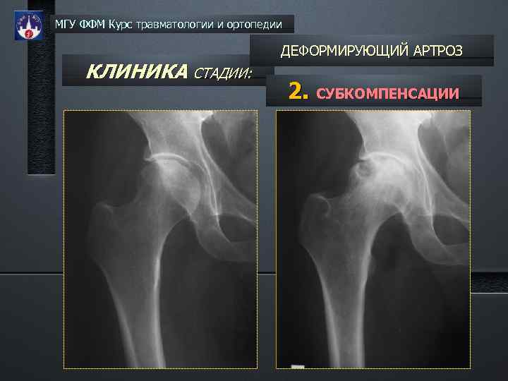 МГУ ФФМ Курс травматологии и ортопедии КЛИНИКА СТАДИИ: ДЕФОРМИРУЮЩИЙ АРТРОЗ 2. СУБКОМПЕНСАЦИИ 