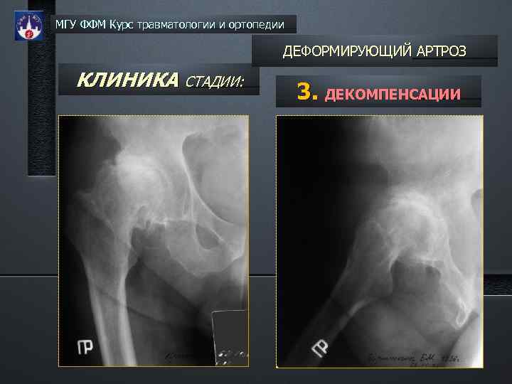 МГУ ФФМ Курс травматологии и ортопедии ДЕФОРМИРУЮЩИЙ АРТРОЗ КЛИНИКА СТАДИИ: 3. ДЕКОМПЕНСАЦИИ 