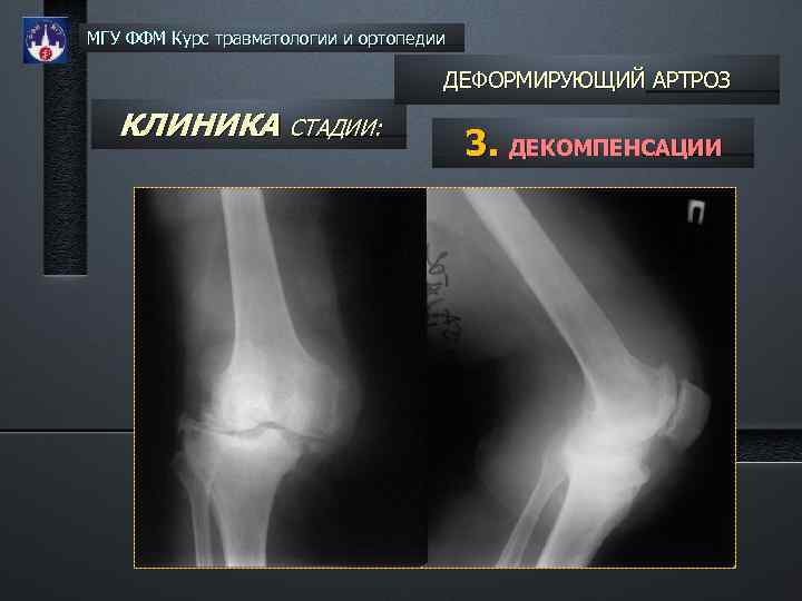 МГУ ФФМ Курс травматологии и ортопедии ДЕФОРМИРУЮЩИЙ АРТРОЗ КЛИНИКА СТАДИИ: 3. ДЕКОМПЕНСАЦИИ 