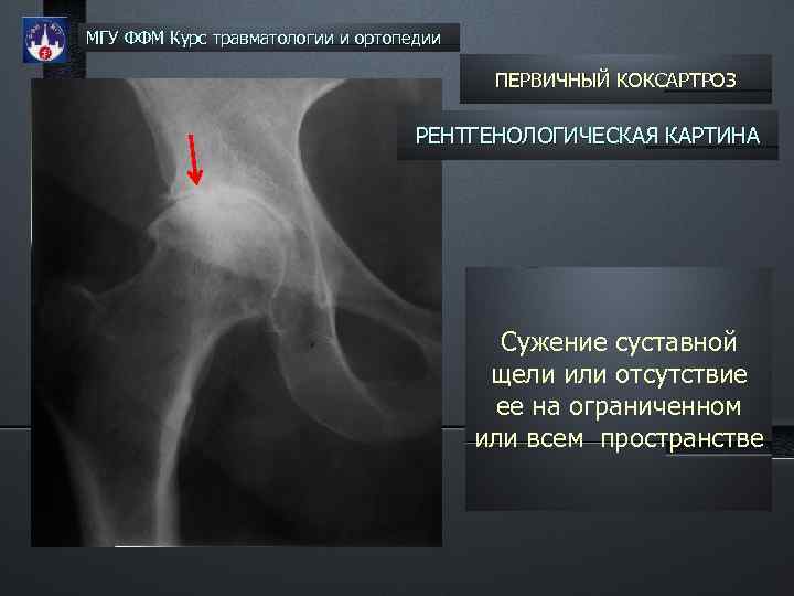 МГУ ФФМ Курс травматологии и ортопедии ПЕРВИЧНЫЙ КОКСАРТРОЗ РЕНТГЕНОЛОГИЧЕСКАЯ КАРТИНА Сужение суставной щели или