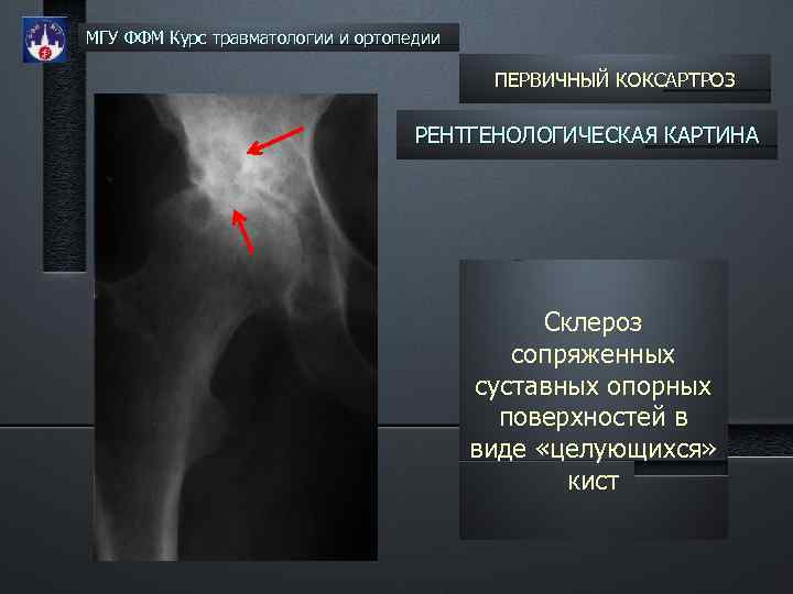 МГУ ФФМ Курс травматологии и ортопедии ПЕРВИЧНЫЙ КОКСАРТРОЗ РЕНТГЕНОЛОГИЧЕСКАЯ КАРТИНА Склероз сопряженных суставных опорных