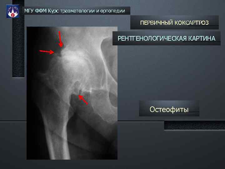 МГУ ФФМ Курс травматологии и ортопедии ПЕРВИЧНЫЙ КОКСАРТРОЗ РЕНТГЕНОЛОГИЧЕСКАЯ КАРТИНА Остеофиты 