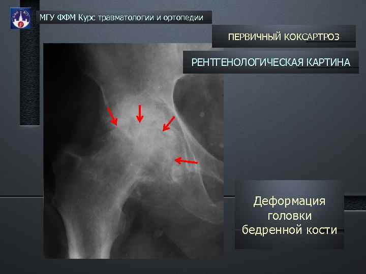 МГУ ФФМ Курс травматологии и ортопедии ПЕРВИЧНЫЙ КОКСАРТРОЗ РЕНТГЕНОЛОГИЧЕСКАЯ КАРТИНА Деформация головки бедренной кости