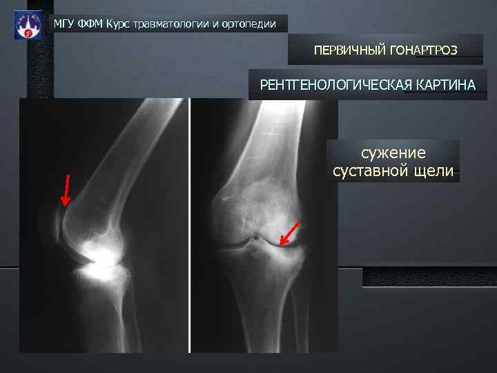 МГУ ФФМ Курс травматологии и ортопедии ПЕРВИЧНЫЙ ГОНАРТРОЗ РЕНТГЕНОЛОГИЧЕСКАЯ КАРТИНА сужение суставной щели 