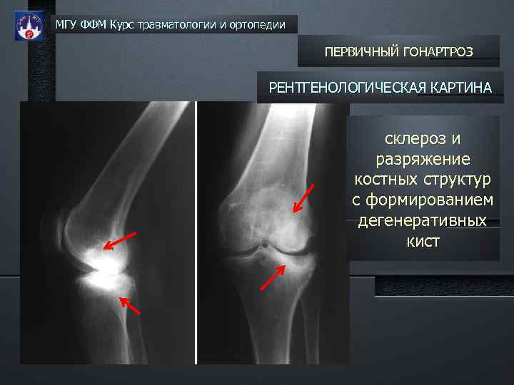 МГУ ФФМ Курс травматологии и ортопедии ПЕРВИЧНЫЙ ГОНАРТРОЗ РЕНТГЕНОЛОГИЧЕСКАЯ КАРТИНА склероз и разряжение костных