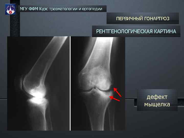 МГУ ФФМ Курс травматологии и ортопедии ПЕРВИЧНЫЙ ГОНАРТРОЗ РЕНТГЕНОЛОГИЧЕСКАЯ КАРТИНА дефект мыщелка 