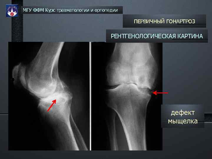 МГУ ФФМ Курс травматологии и ортопедии ПЕРВИЧНЫЙ ГОНАРТРОЗ РЕНТГЕНОЛОГИЧЕСКАЯ КАРТИНА дефект мыщелка 