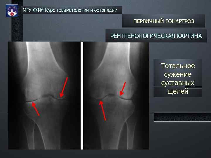 МГУ ФФМ Курс травматологии и ортопедии ПЕРВИЧНЫЙ ГОНАРТРОЗ РЕНТГЕНОЛОГИЧЕСКАЯ КАРТИНА Тотальное сужение суставных щелей