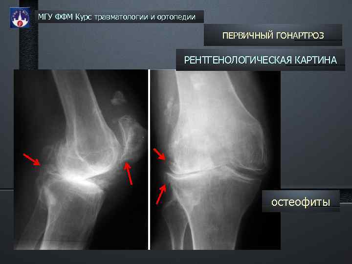 МГУ ФФМ Курс травматологии и ортопедии ПЕРВИЧНЫЙ ГОНАРТРОЗ РЕНТГЕНОЛОГИЧЕСКАЯ КАРТИНА остеофиты 