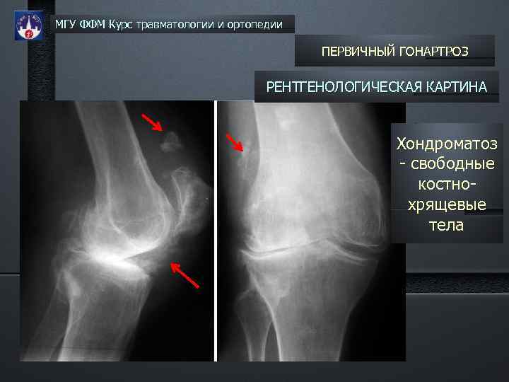 МГУ ФФМ Курс травматологии и ортопедии ПЕРВИЧНЫЙ ГОНАРТРОЗ РЕНТГЕНОЛОГИЧЕСКАЯ КАРТИНА Хондроматоз - свободные костнохрящевые