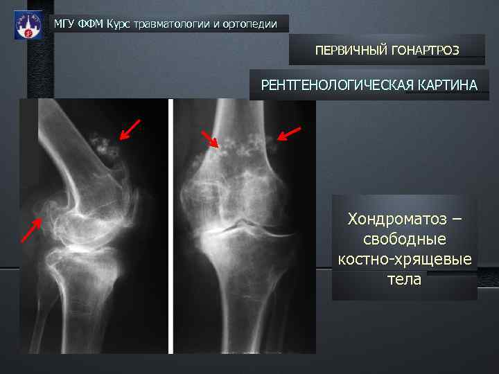 Первичный гонартроз двусторонний что это. Гонартроз коленного сустава рентген. Гонартроз рентген стадии. Гонартроз 3 степени коленного сустава на рентгене описание. Рентген степени гонартроза 2-3.