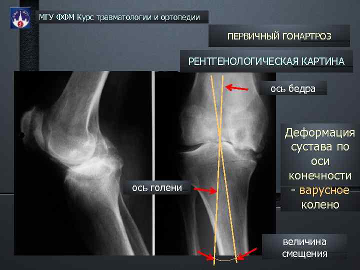 МГУ ФФМ Курс травматологии и ортопедии ПЕРВИЧНЫЙ ГОНАРТРОЗ РЕНТГЕНОЛОГИЧЕСКАЯ КАРТИНА ось бедра ось голени