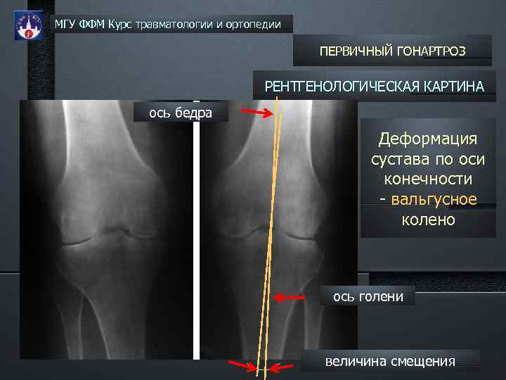 МГУ ФФМ Курс травматологии и ортопедии ПЕРВИЧНЫЙ ГОНАРТРОЗ РЕНТГЕНОЛОГИЧЕСКАЯ КАРТИНА ось бедра Деформация сустава