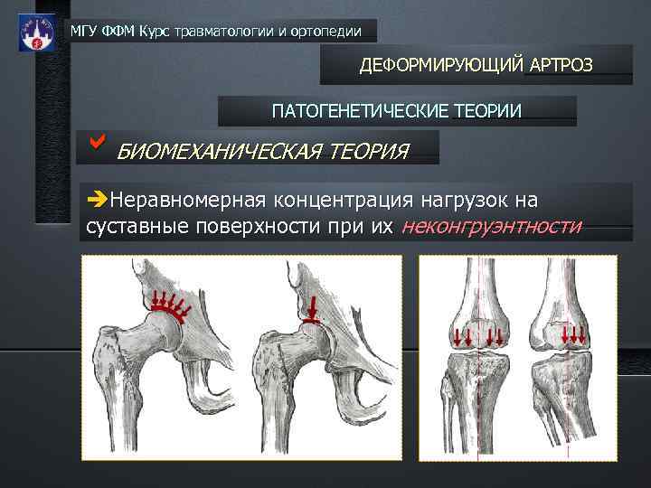 МГУ ФФМ Курс травматологии и ортопедии ДЕФОРМИРУЮЩИЙ АРТРОЗ ПАТОГЕНЕТИЧЕСКИЕ ТЕОРИИ b. БИОМЕХАНИЧЕСКАЯ ТЕОРИЯ Неравномерная