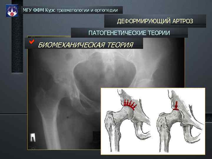 МГУ ФФМ Курс травматологии и ортопедии ДЕФОРМИРУЮЩИЙ АРТРОЗ ПАТОГЕНЕТИЧЕСКИЕ ТЕОРИИ b. БИОМЕХАНИЧЕСКАЯ ТЕОРИЯ 