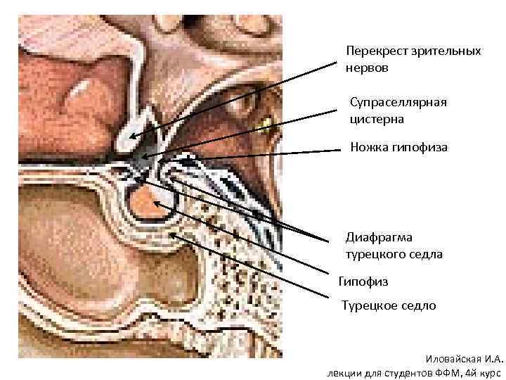 Супраселлярная цистерна пролабирует в полость