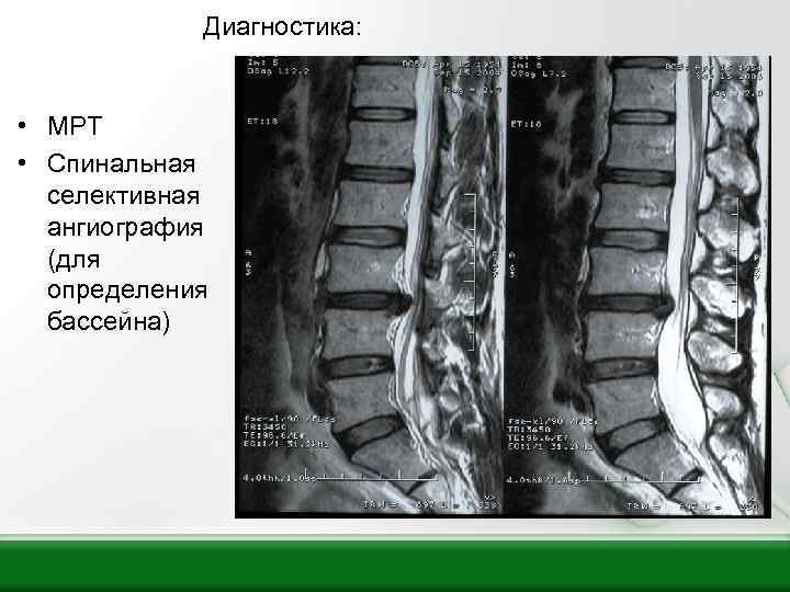 Диагностика: • МРТ • Спинальная селективная ангиография (для определения бассейна) 