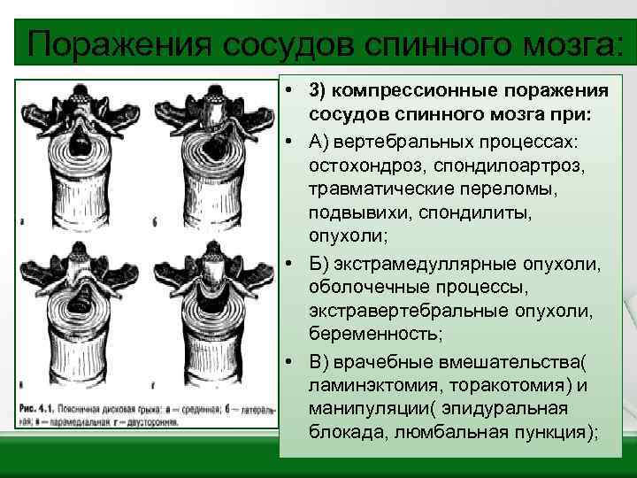 Поражения сосудов спинного мозга: • 3) компрессионные поражения сосудов спинного мозга при: • А)