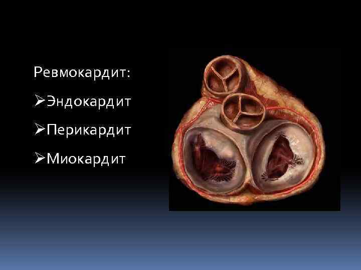 Ревмокардит: ØЭндокардит ØПерикардит ØМиокардит 