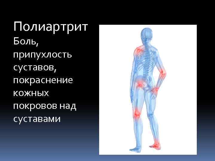 Полиартрит Боль, припухлость суставов, покраснение кожных покровов над суставами 