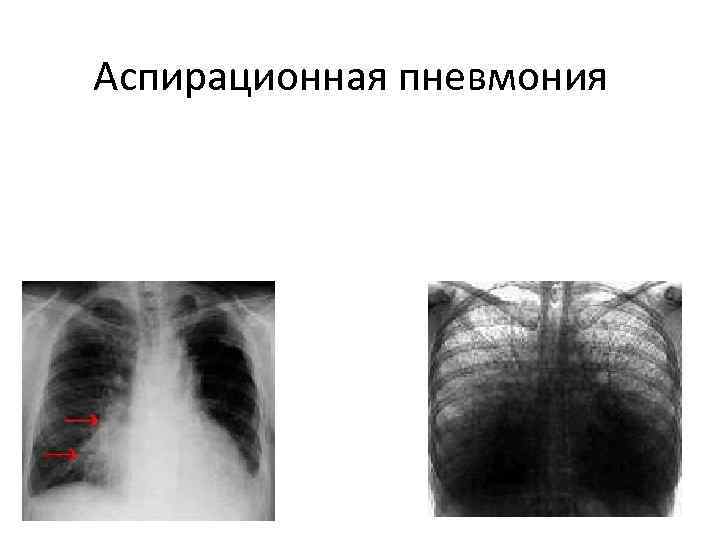 Аспирационная пневмония 