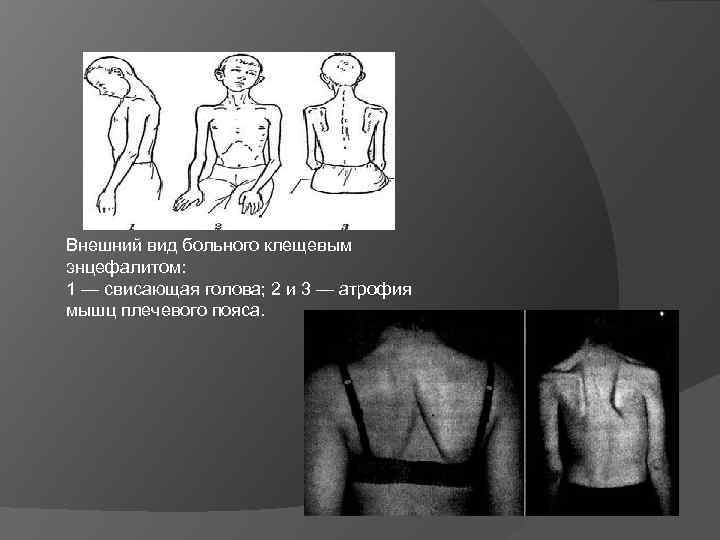 Внешний вид больного клещевым энцефалитом: 1 — свисающая голова; 2 и 3 — атрофия