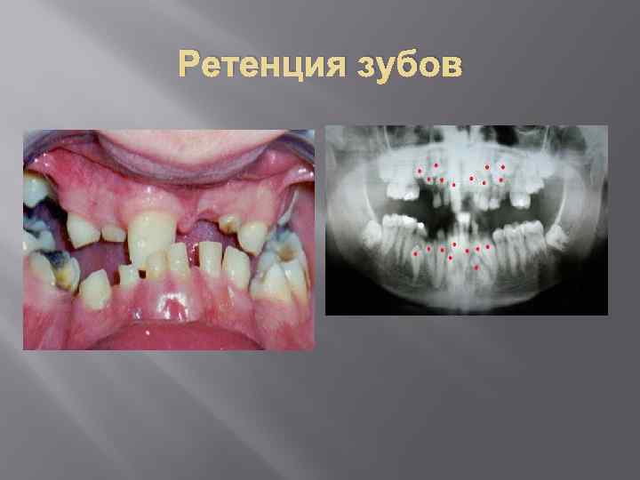 Ретенция зубов 