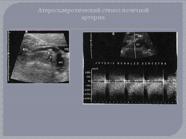 Атеросклеротический стеноз почечной артерии. 