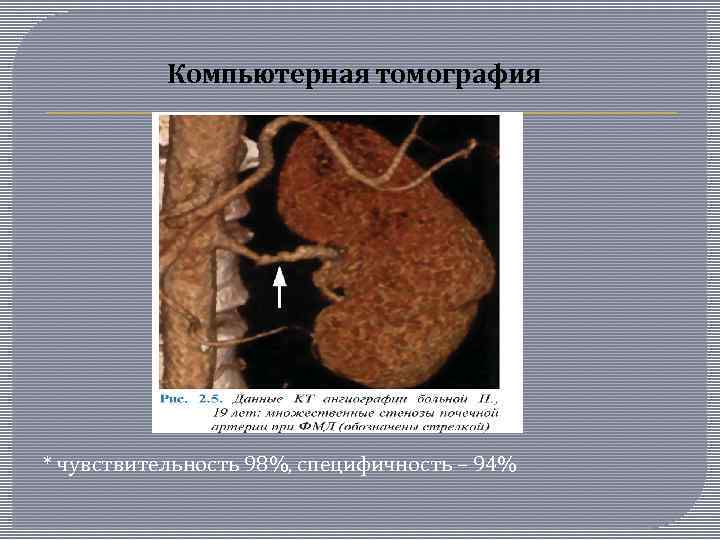 Компьютерная томография * чувствительность 98%, специфичность – 94% 