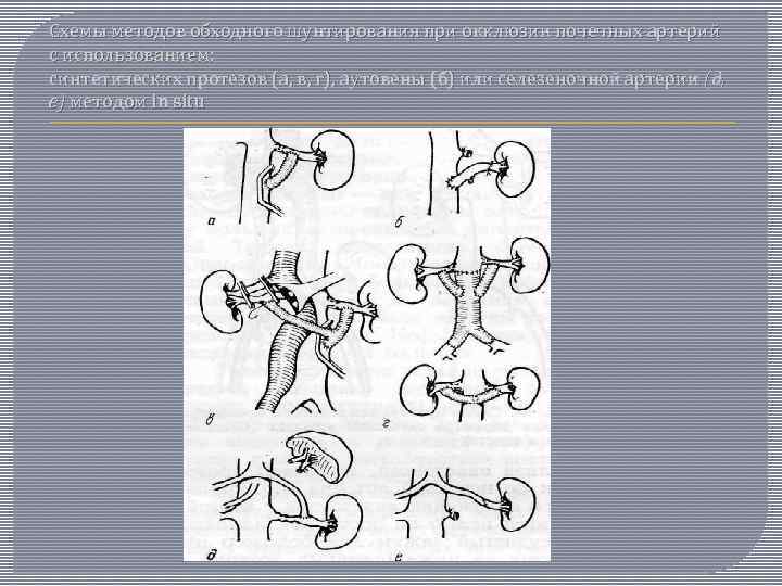 Схемы методов обходного шунтирования при окклюзии почечных артерий с использованием: синтетических протезов (а, в,