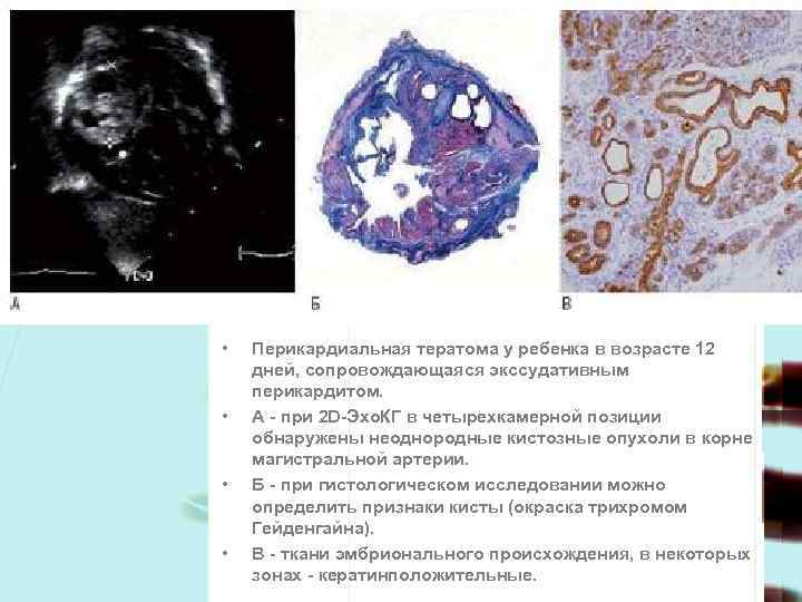  • • Перикардиальная тератома у ребенка в возрасте 12 дней, сопровождающаяся экссудативным перикардитом.