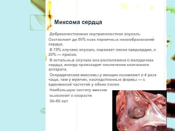 Миксома сердца Доброкачественная внутриполостная опухоль Составляет до 50% всех первичных новообразований сердца. В 75%