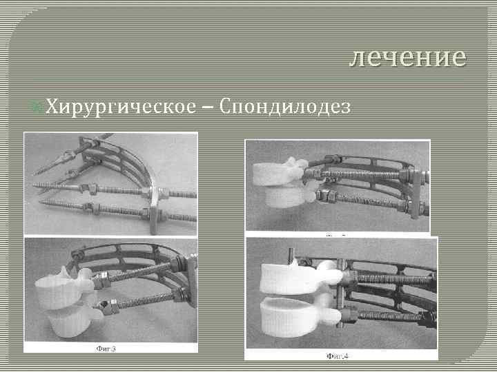 лечение Хирургическое – Спондилодез 