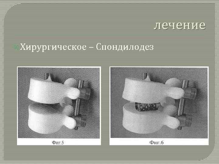 лечение Хирургическое – Спондилодез 