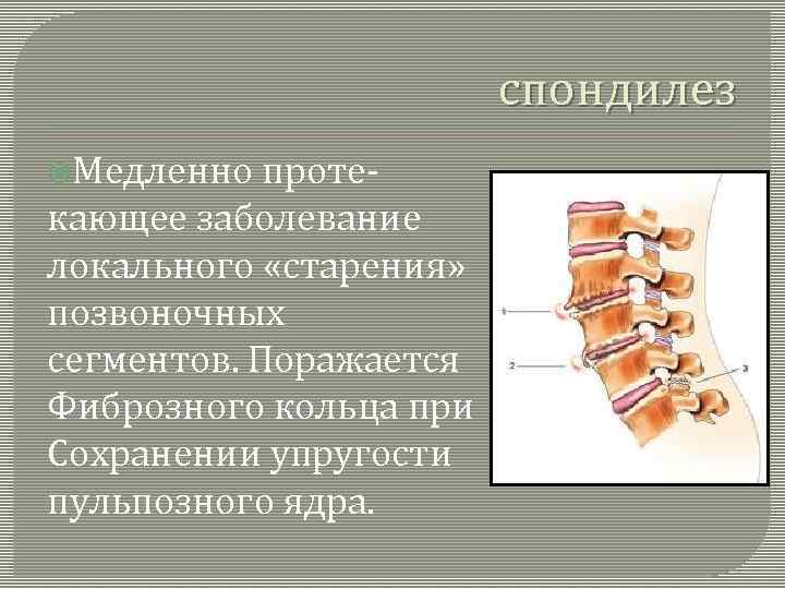 спондилез Медленно проте- кающее заболевание локального «старения» позвоночных сегментов. Поражается Фиброзного кольца при Сохранении