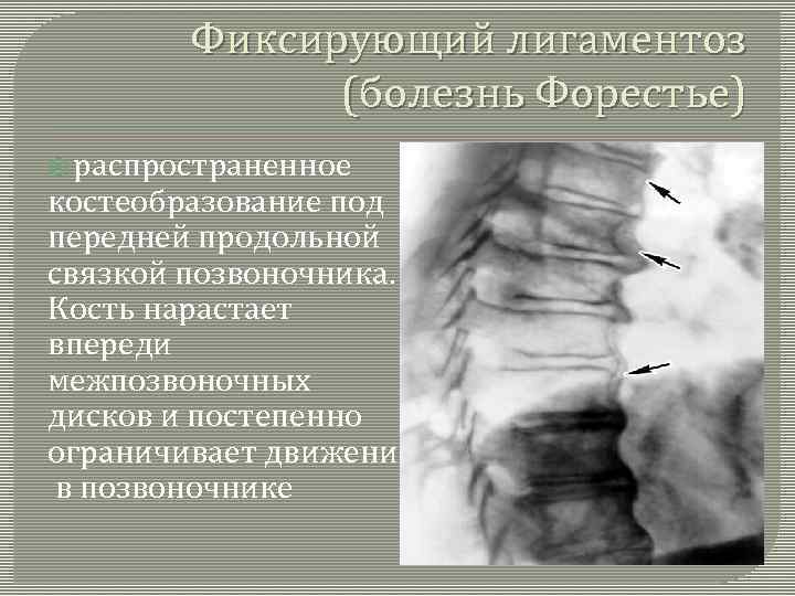 Фиксирующий лигаментоз (болезнь Форестье) распространенное костеобразование под передней продольной связкой позвоночника. Кость нарастает впереди