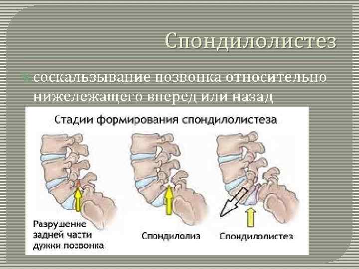 Спондилолистез соскальзывание позвонка относительно нижележащего вперед или назад 