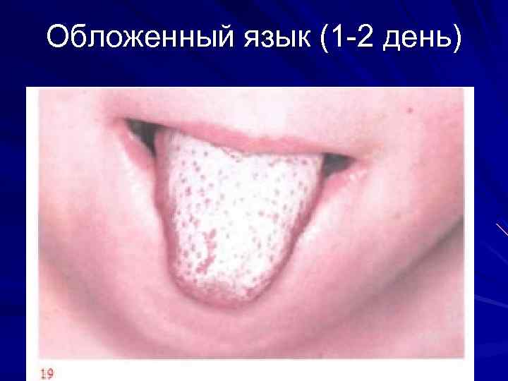 Обложенный язык (1 -2 день) 