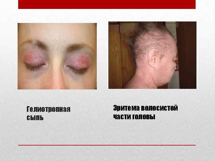 Гелиотропная сыпь Эритема волосистой части головы 