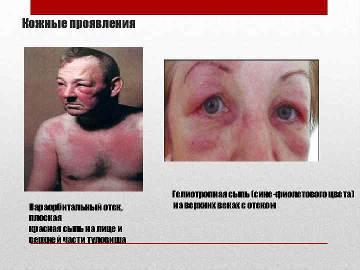 Кожные проявления Параорбитальный отек, плоская красная сыпь на лице и верхней части туловища Гелиотропная